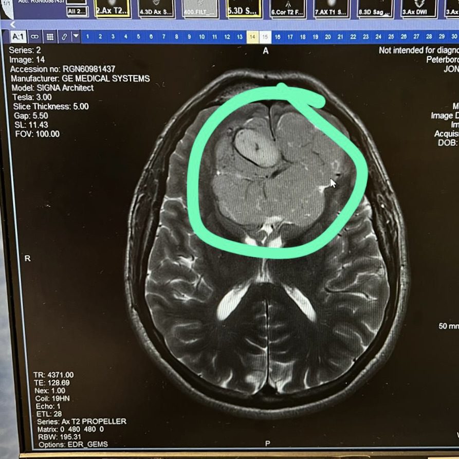 Blog Tumour